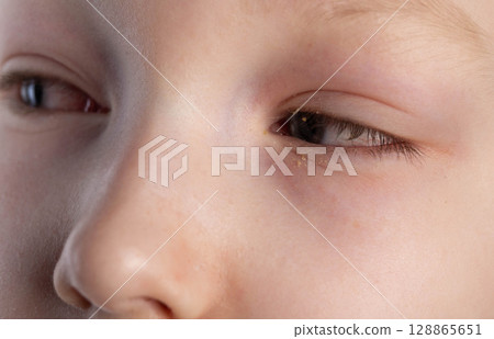 A girl has sore and red eyes after conjunctivitis, pain and pain in the eyes. Bacterial infection, close-up A girl has sore and red eyes after conjunctivitis, pain and pain in the eyes. Bacterial infection, close-up 128865651