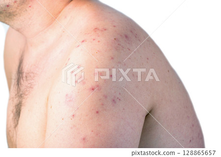 Red spots and rashes on the skin of a man s shoulders due to a reaction to alcohol. Alcohol intolerance, enzyme deficiency, allergies, close-up 128865657