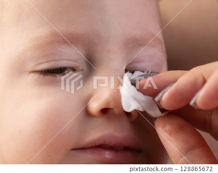 A mother wipes the eyes of a little boy with a cotton pad to remove pus and bacteria due to allergies and conjunctivitis. Eye hygiene for children, close-up 128865672