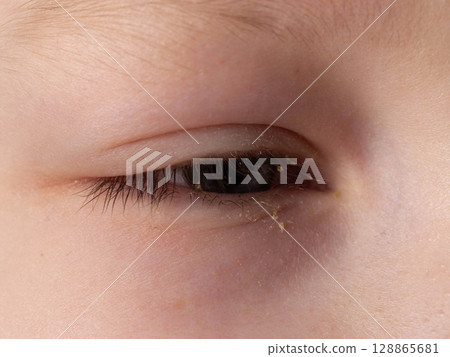 Painful red eye of a girl during a viral cold. Inflammation conjunctivitis, macro Painful red eye of a girl during a viral cold. Inflammation conjunctivitis, macro 128865681