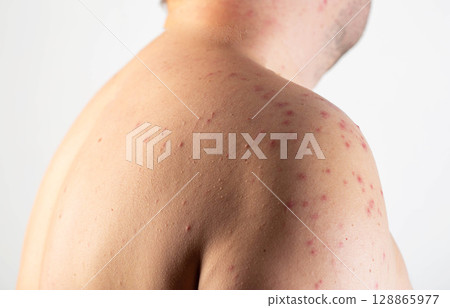 Red spots and rashes on the skin of a man s shoulders due to a reaction to alcohol. Alcohol intolerance, enzyme deficiency, allergies, close-up Red spots and rashes on the skin of a man s shoulders due to a reaction to alcohol. Alcohol intolerance, enzyme deficiency, allergies, close-up 128865977