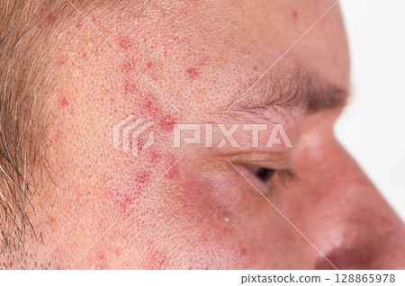 Red spots and rashes on the scalp and eyes. Alcohol intolerance, alcoholic urticaria, allergies, close-up Red spots and rashes on the scalp and eyes. Alcohol intolerance, alcoholic urticaria, allergies, close-up 128865978