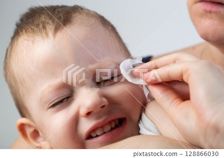 A mother wipes the eyes of a little boy with a cotton pad to remove pus and bacteria due to allergies and conjunctivitis. Eye hygiene for children, close-up A mother wipes the eyes of a little boy with a cotton pad to remove pus and bacteria due to allergies and conjunctivitis. Eye hygiene for children, close-up 128866030