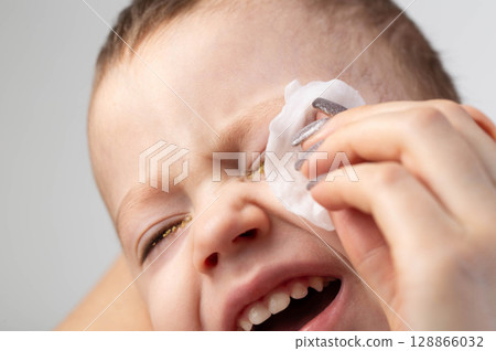 Wiping the eyes of a little boy with a cotton pad from pus due to conjunctivitis. Treatment of bacterial conjunctivitis, close-up Wiping the eyes of a little boy with a cotton pad from pus due to conjunctivitis. Treatment of bacterial conjunctivitis, close-up 128866032