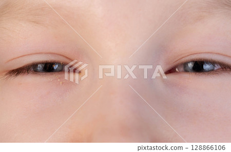 The girl has swollen, reddened, painful eyes. Inflammation of conjunctivitis, pus in the eyes. Bacterial infection, close-up 128866106