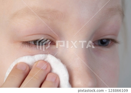 A girl wipes her eyes with a cotton pad to remove pus from her eyes due to conjunctivitis. Bacterial infection, close-up 128866109