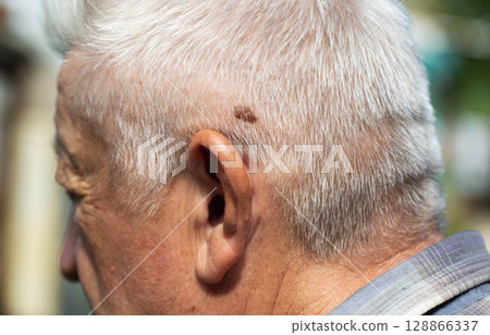 Brown mole on the head of an elderly person, nevus and melanoma, close-up, dermatology Brown mole on the head of an elderly person, nevus and melanoma, close-up, dermatology 128866337