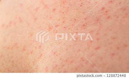 Red pimples and rashes on female skin. Concept of chronic dermatological diseases, allergy to drugs, eczema Red pimples and rashes on female skin. Concept of chronic dermatological diseases, allergy to drugs, eczema 128872448