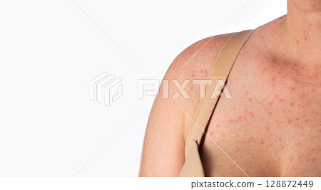 Red rashes and pimples on the skin of a woman's chest due to allergies, close-up. Copy space for text, chronic diseases Red rashes and pimples on the skin of a woman's chest due to allergies, close-up. Copy space for text, chronic diseases 128872449