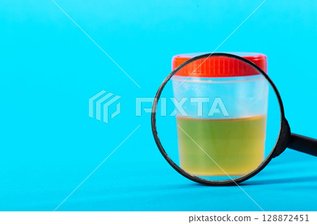 Container with urine test under a magnifying glass on a blue background. Hematuria and protein in the urine. Prostatitis and cystitis in urology. Copy space for text, escherichia coli Container with urine test under a magnifying glass on a blue background. Hematuria and protein in the urine. Prostatitis and cystitis in urology. Copy space for text, escherichia coli 128872451