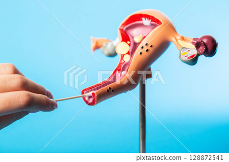 Girl's hand takes a smear on flora from a female medical model on a blue background. Concept of sexually transmitted infections chlamydia and trichomonas, venereology Girl's hand takes a smear on flora from a female medical model on a blue background. Concept of sexually transmitted infections chlamydia and trichomonas, venereology 128872541