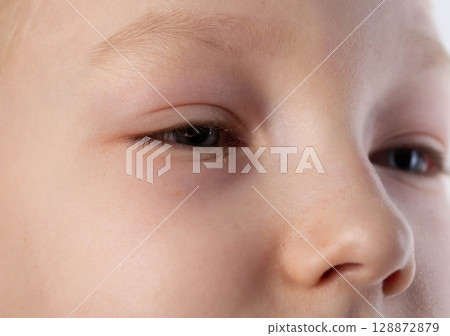 The girl has swollen, reddened, painful eyes. Inflammation of conjunctivitis, pus in the eyes. Bacterial infection, close-up The girl has swollen, reddened, painful eyes. Inflammation of conjunctivitis, pus in the eyes. Bacterial infection, close-up 128872879