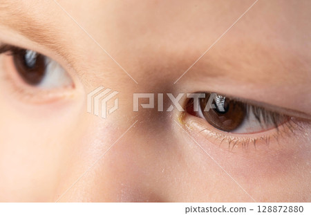 Bacterial infection in the eyes of a little boy, conjunctivitis, pus in the eyes, close-up Bacterial infection in the eyes of a little boy, conjunctivitis, pus in the eyes, close-up 128872880