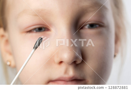 An eye swab for infections and bacteria in a girl with conjunctivitis. Determination of the causative agent of infection, close-up An eye swab for infections and bacteria in a girl with conjunctivitis. Determination of the causative agent of infection, close-up 128872881