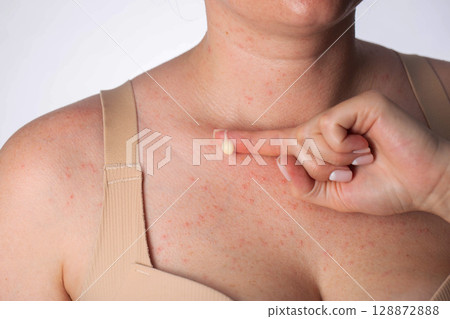 A girl smears red pimples on her body skin with healing ointment after dermatological irritation, close-up 128872888