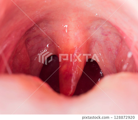 Uvulitis and sore throat in the oral cavity due to illness. Inflammation of the uvula and tonsils due to infections during illness, close-up, streptococcus. Allergy Uvulitis and sore throat in the oral cavity due to illness. Inflammation of the uvula and tonsils due to infections during illness, close-up, streptococcus. Allergy 128872920