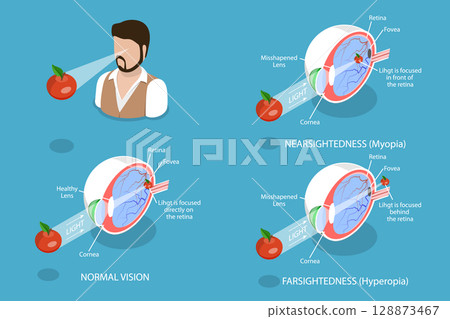 3D Isometric Flat Vector Illustration of Vision Disorder, Far-Sightedness And Near-Sightedness Anatomical Diagram 128873467