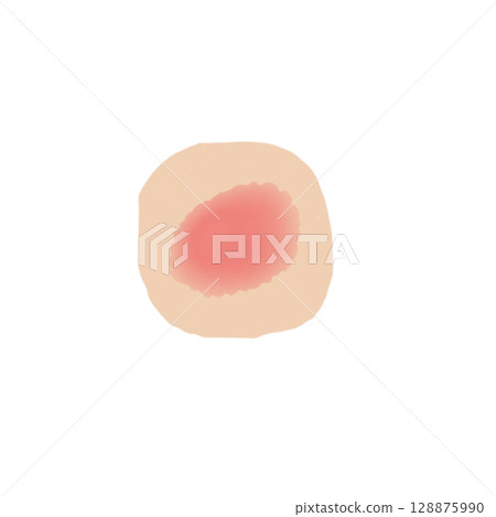 Redness | Skin inflammation illustration material (transparent PNG) Erythema Skin Condition Illus 128875990