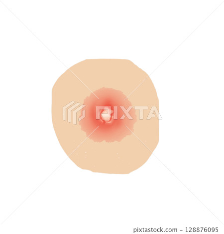 Abscess | Illustration of a state in which pus accumulates under the skin (transparent PNG) Abscess Medical Illust Abscess | Illustration of a state in which pus accumulates under the skin (transparent PNG) Abscess Medical Illust 128876095