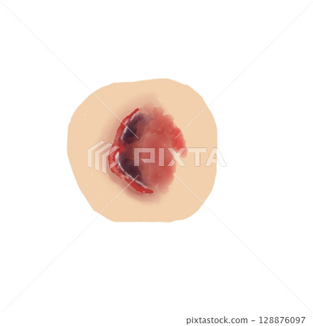 Epidermal Detachment I | Illustration of skin peeling (transparent PNG) 128876097