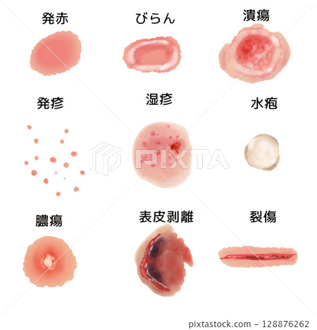 皮膚病變插圖集 | 發紅、糜爛、潰瘍等9種(透明PNG)皮膚病變插圖 皮膚病變插圖集 | 發紅、糜爛、潰瘍等9種(透明PNG)皮膚病變插圖 128876262