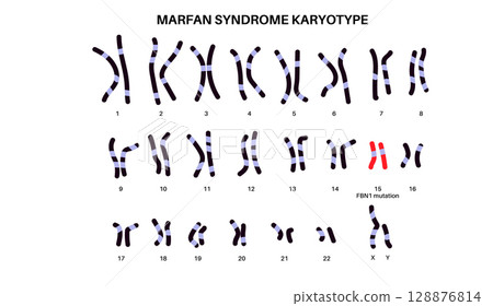 Marfan syndrome poster 128876814