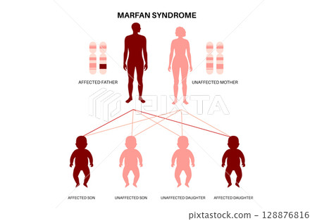 Marfan syndrome poster Marfan syndrome poster 128876816