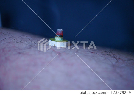 Moxibustion is a traditional Chinese medicine that stimulates acupressure points to improve physical condition. Moxibustion is a traditional Chinese medicine that stimulates acupressure points to improve physical condition. 128879269