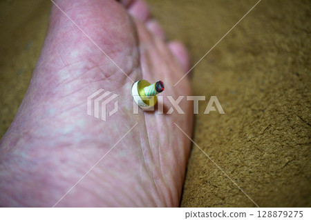 Moxibustion is a traditional Chinese medicine that stimulates acupressure points to improve physical condition. Moxibustion is a traditional Chinese medicine that stimulates acupressure points to improve physical condition. 128879275