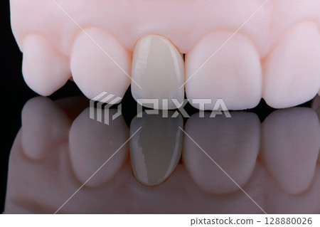Lateral maxillary incisor made of zirconium, ultra thin dental ceramic veneer crown on printed model 128880026
