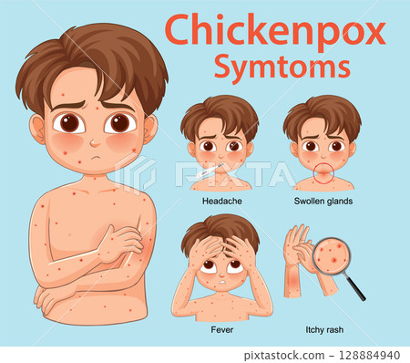 Chickenpox Symptoms Illustrated in Young Child Vector 128884940