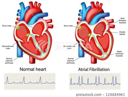 Comparison of Normal Heart and Atrial Fibrillation 128884961