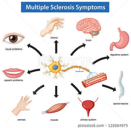 Vector Diagram Illustrating Multiple Sclerosis Symptoms and Effects 128884975