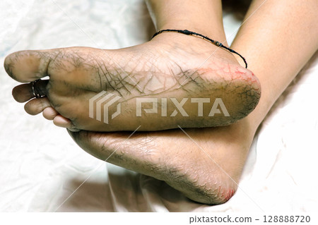 Close-Up of Cracked Heels and Bare Feet 128888720
