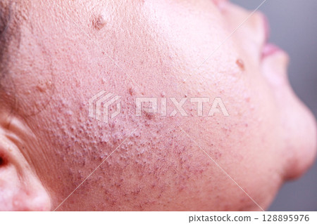 Skin face after removing hair Skin face after removing hair 128895976