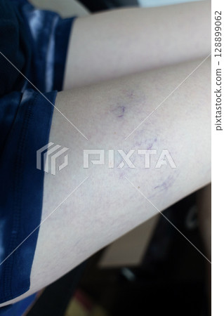 Close up image of spider veins on a womans leg during a medical examination. Visible varicose capillaries, teleangiectasia, or vascular stars. Concept of venous disease, pregnancy aftermath Close up image of spider veins on a womans leg during a medical examination. Visible varicose capillaries, teleangiectasia, or vascular stars. Concept of venous disease, pregnancy aftermath 128899062