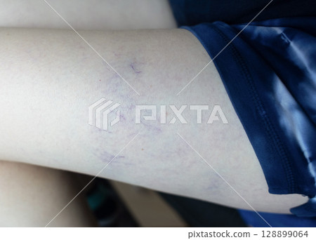 Close up image of spider veins on a womans leg during a medical examination. Visible varicose capillaries, teleangiectasia, or vascular stars. Concept of venous disease, pregnancy aftermath 128899064