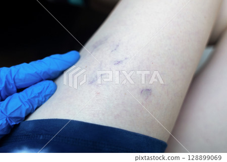Close up image of spider veins on a womans leg during a medical examination. Visible varicose capillaries, teleangiectasia, or vascular stars. Concept of venous disease, pregnancy aftermath 128899069