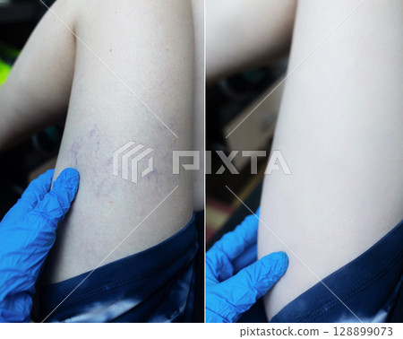 Close up image of spider veins on a womans leg during a medical examination. Visible varicose capillaries, teleangiectasia, or vascular stars. Concept of venous disease, pregnancy aftermath 128899073