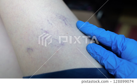 Close up image of spider veins on a womans leg during a medical examination. Visible varicose capillaries, teleangiectasia, or vascular stars. Concept of venous disease, pregnancy aftermath Close up image of spider veins on a womans leg during a medical examination. Visible varicose capillaries, teleangiectasia, or vascular stars. Concept of venous disease, pregnancy aftermath 128899074