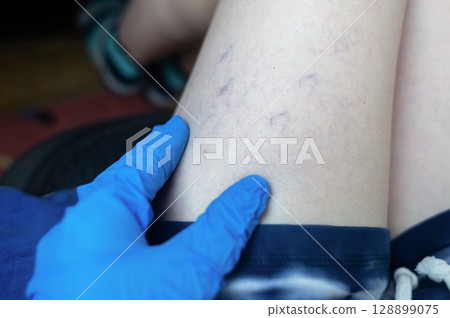 Close up image of spider veins on a womans leg during a medical examination. Visible varicose capillaries, teleangiectasia, or vascular stars. Concept of venous disease, pregnancy aftermath Close up image of spider veins on a womans leg during a medical examination. Visible varicose capillaries, teleangiectasia, or vascular stars. Concept of venous disease, pregnancy aftermath 128899075