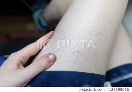 Close up image of spider veins on a womans leg during a medical examination. Visible varicose capillaries, teleangiectasia, or vascular stars. Concept of venous disease, pregnancy aftermath 128899076