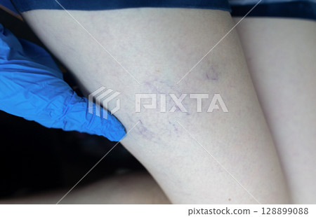 Close up image of spider veins on a womans leg during a medical examination. Visible varicose capillaries, teleangiectasia, or vascular stars. Concept of venous disease, pregnancy aftermath 128899088