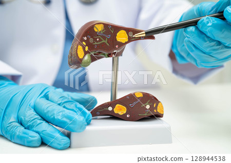 Cirrhosis, Liver cancer, fatty liver, Asian doctor with liver human anatomy model in World Hepatitis Day at hospital. 128944538