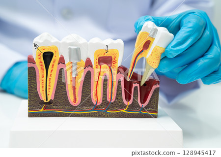Dentist holding dental implant, artificial tooth roots into jaw, root canal of dental treatment, gum disease, teeth model for dentist. Dentist holding dental implant, artificial tooth roots into jaw, root canal of dental treatment, gum disease, teeth model for dentist. 128945417