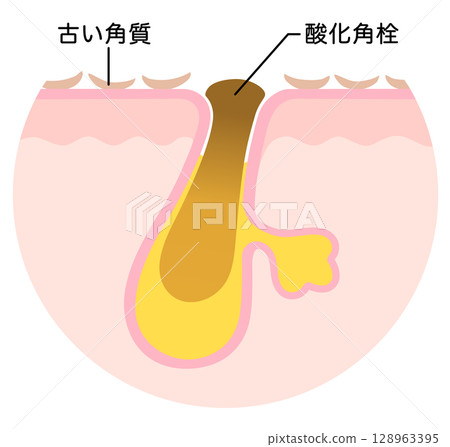 Oxidized keratin plugs and old keratin plugs - Cross-section of a pore clogged with keratin plugs Oxidized keratin plugs and old keratin plugs - Cross-section of a pore clogged with keratin plugs 128963395