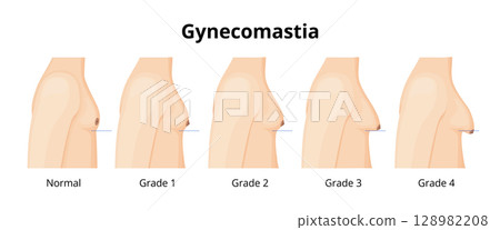 Gynecomastia Stages Showing Different Breast Sizes 128982208