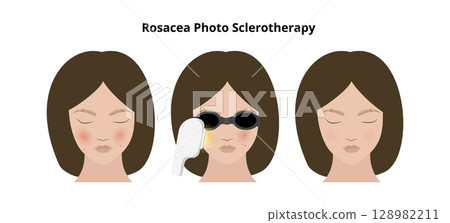 Woman undergoing rosacea photosclerotherapy treatment 128982211