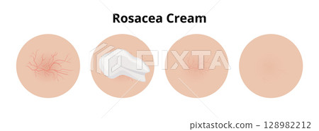 Cream treating rosacea, before and after effect 128982212