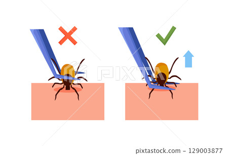 Removing encephalitis ticks after bite. How to remove mite. Parasite carrying disease. Tick grabbed into skin, it is removed with tweezers. First aid. Prevention of infections transmitted by mites 129003877